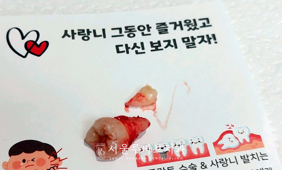 사랑니발치 후 주의사항