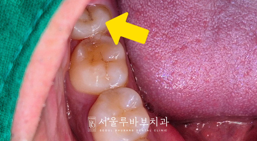 사랑니발치