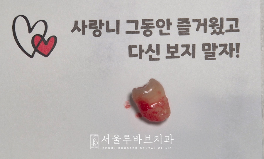 사랑니발치후주의사항
