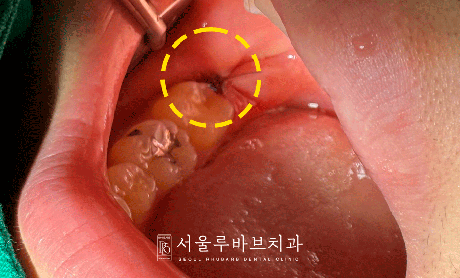 파주사랑니발치